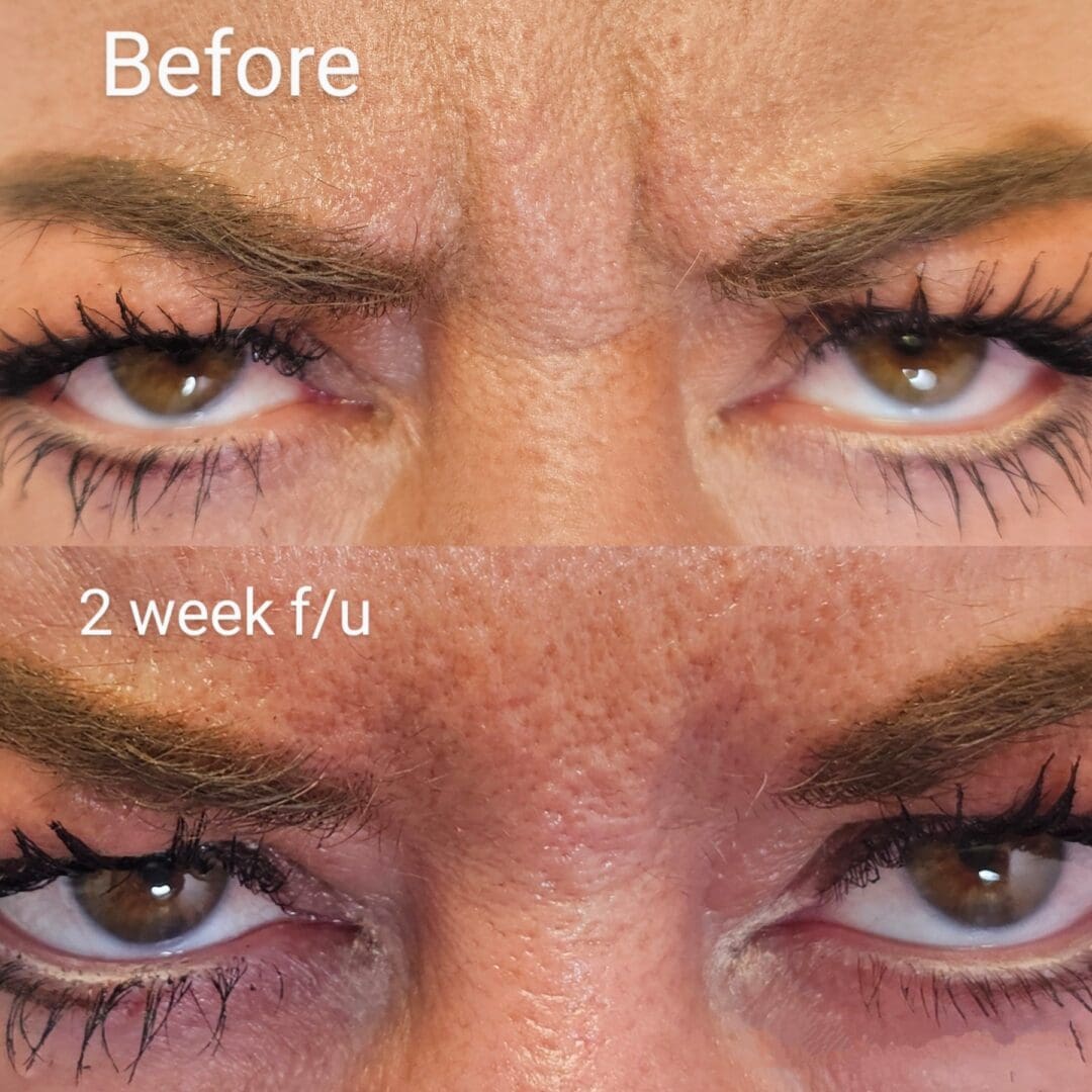 A woman 's eyes before and after using botox.