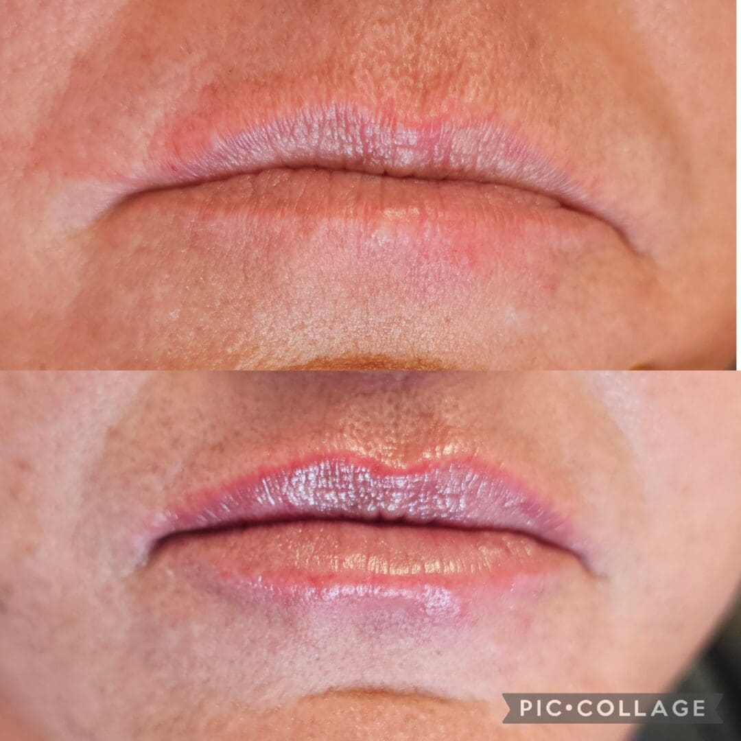 A before and after photo of the lips of a woman.