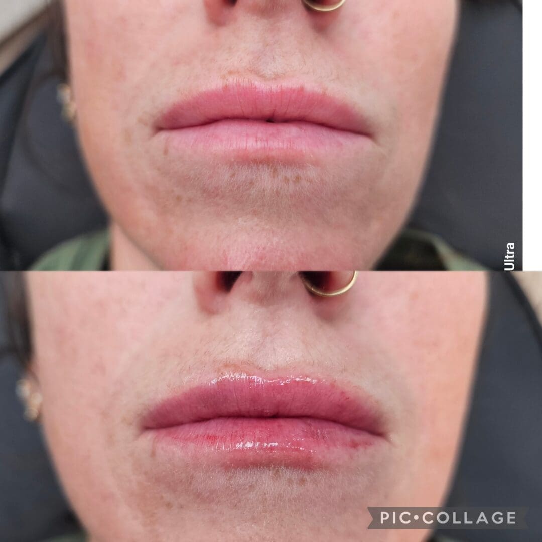 A before and after photo of a woman 's lips.