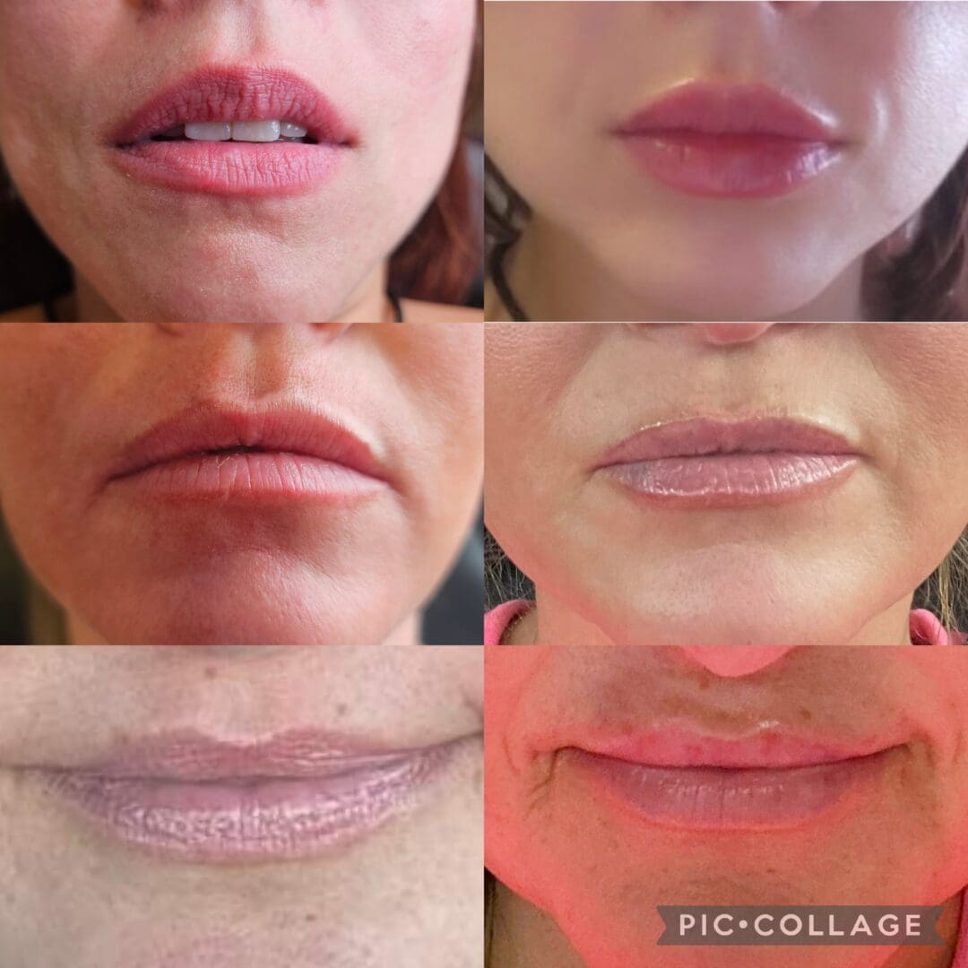 A collage of different stages of lip augmentation.