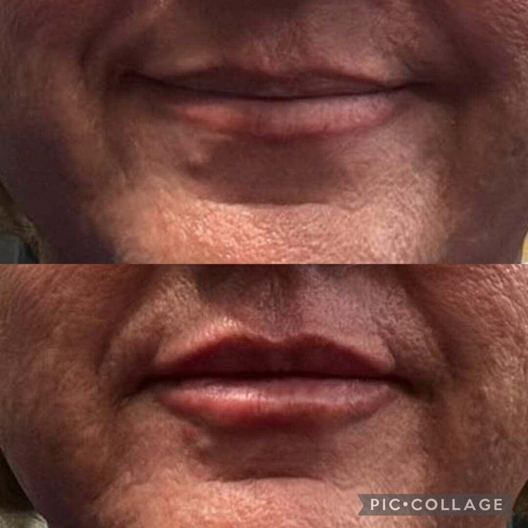 A man with a mustache and no beard is shown before and after his lip augmentation.