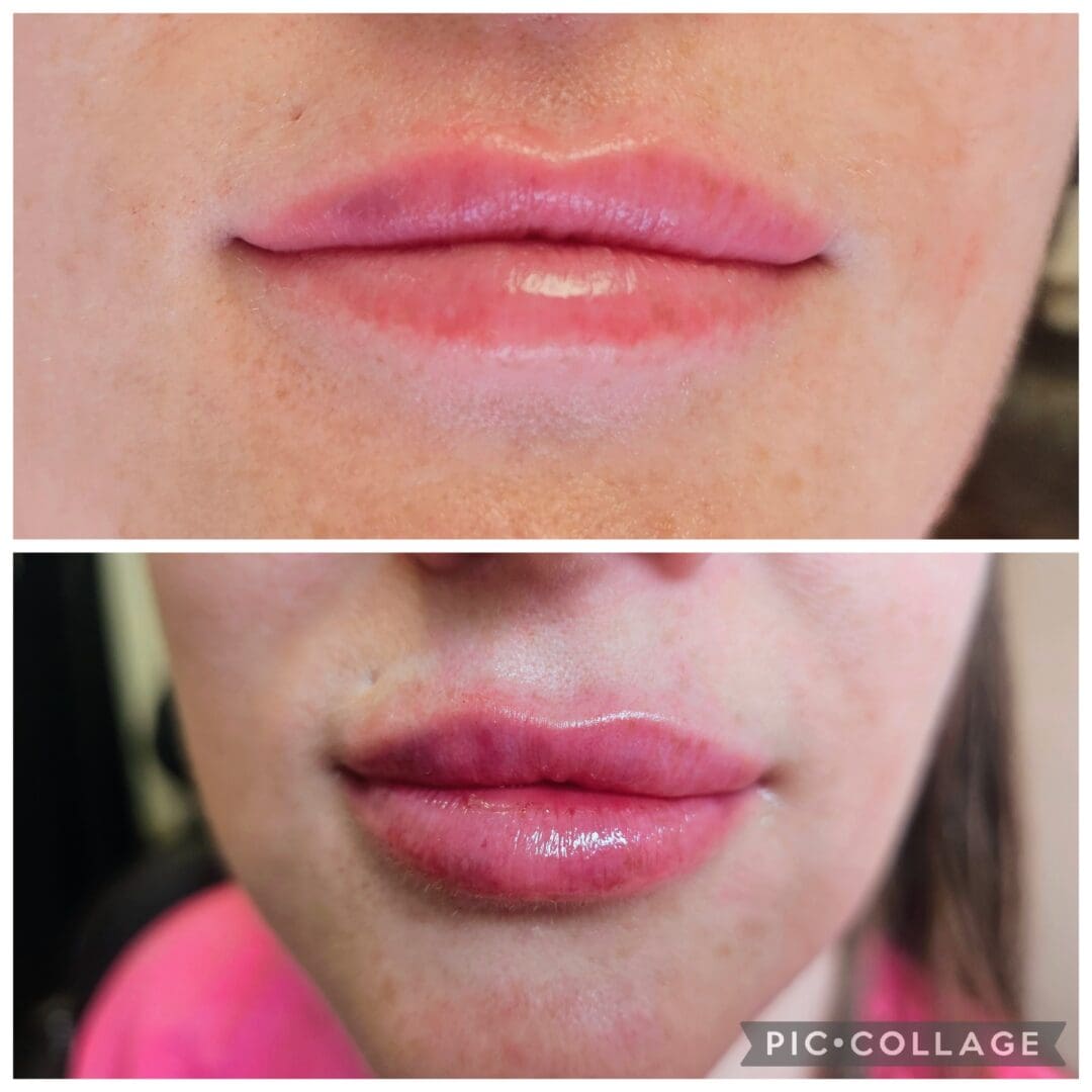 A woman 's lips before and after lip augmentation.