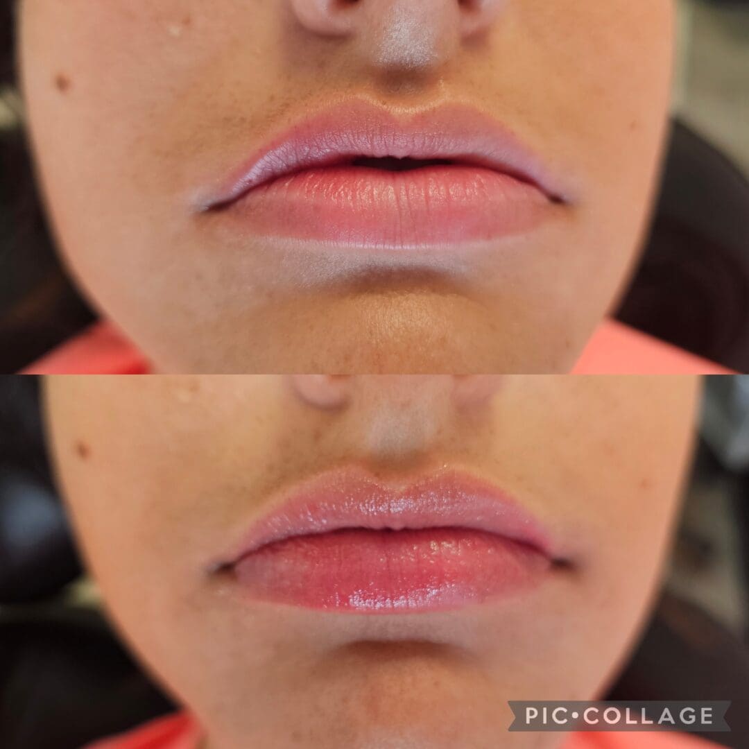 Before and after photo of a woman 's lips